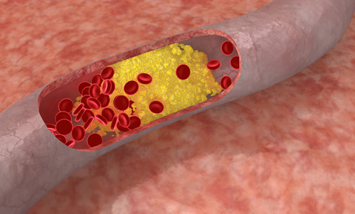 cholesterol