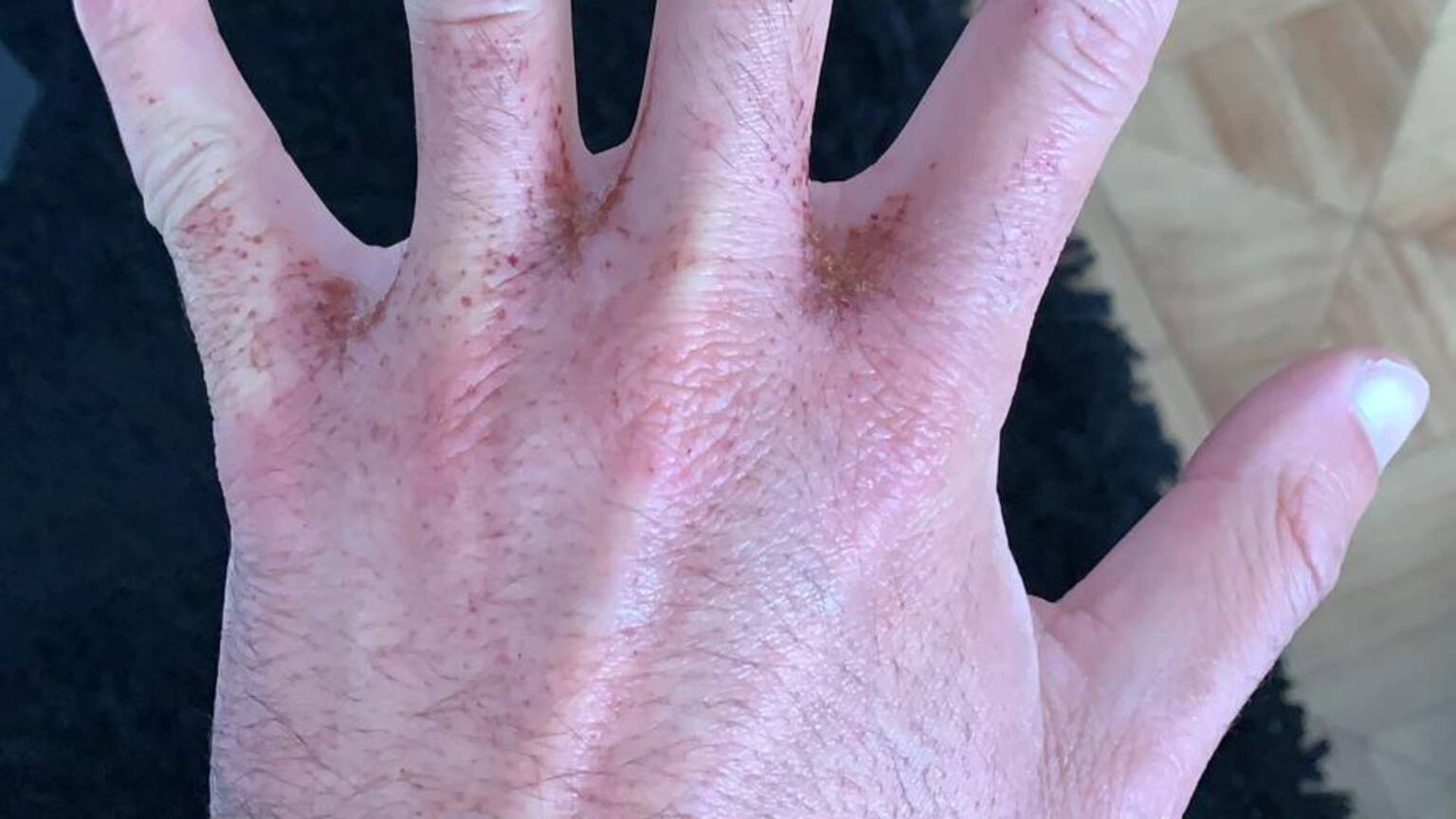 Customers suffer burns after hand gel mixed up with drain cleaner DutchNews.nl