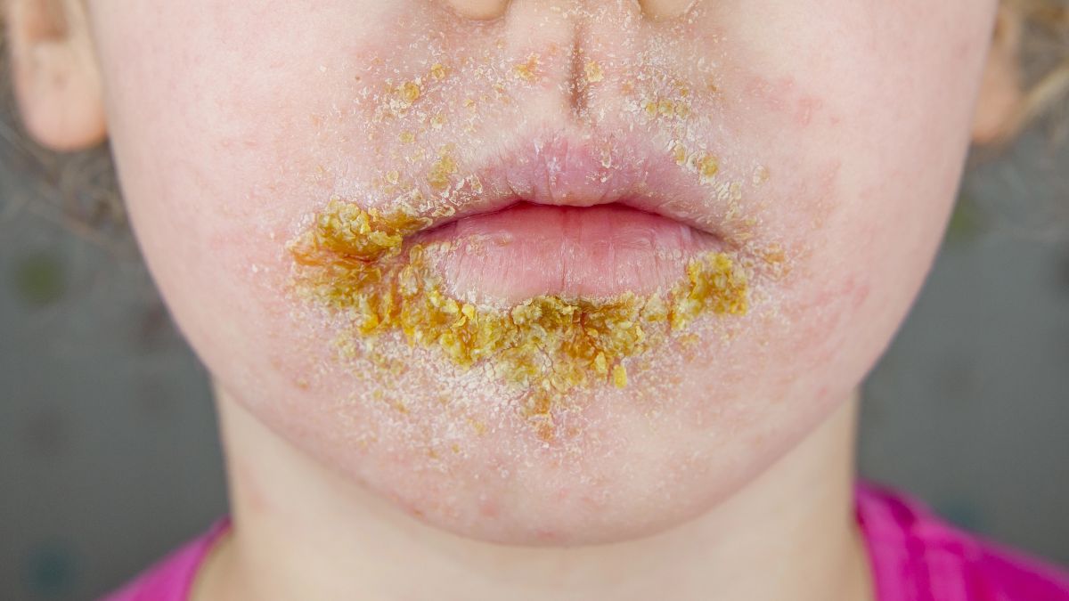 Zeer besmettelijke impetigo-infectie neemt toe onder kinderen Zeer besmettelijke impetigo-infectie neemt toe onder kinderen